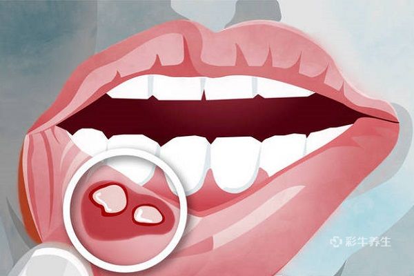 口腔溃疡是什么原因造成