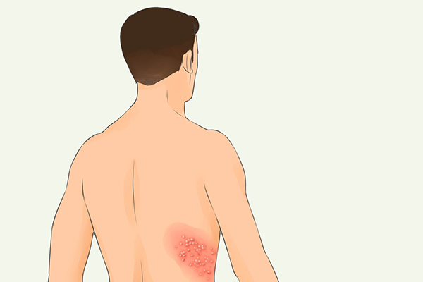 男性疱疹的原因 疱疹的治疗方法